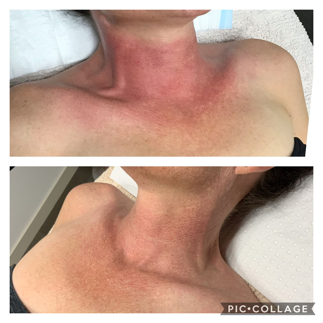 Redness-before & after image