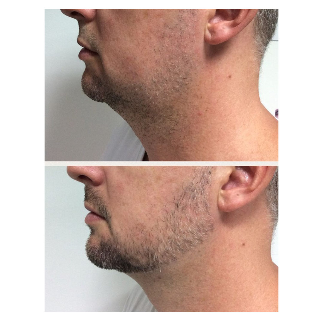 Skin-Tightening-before-&-after-image
