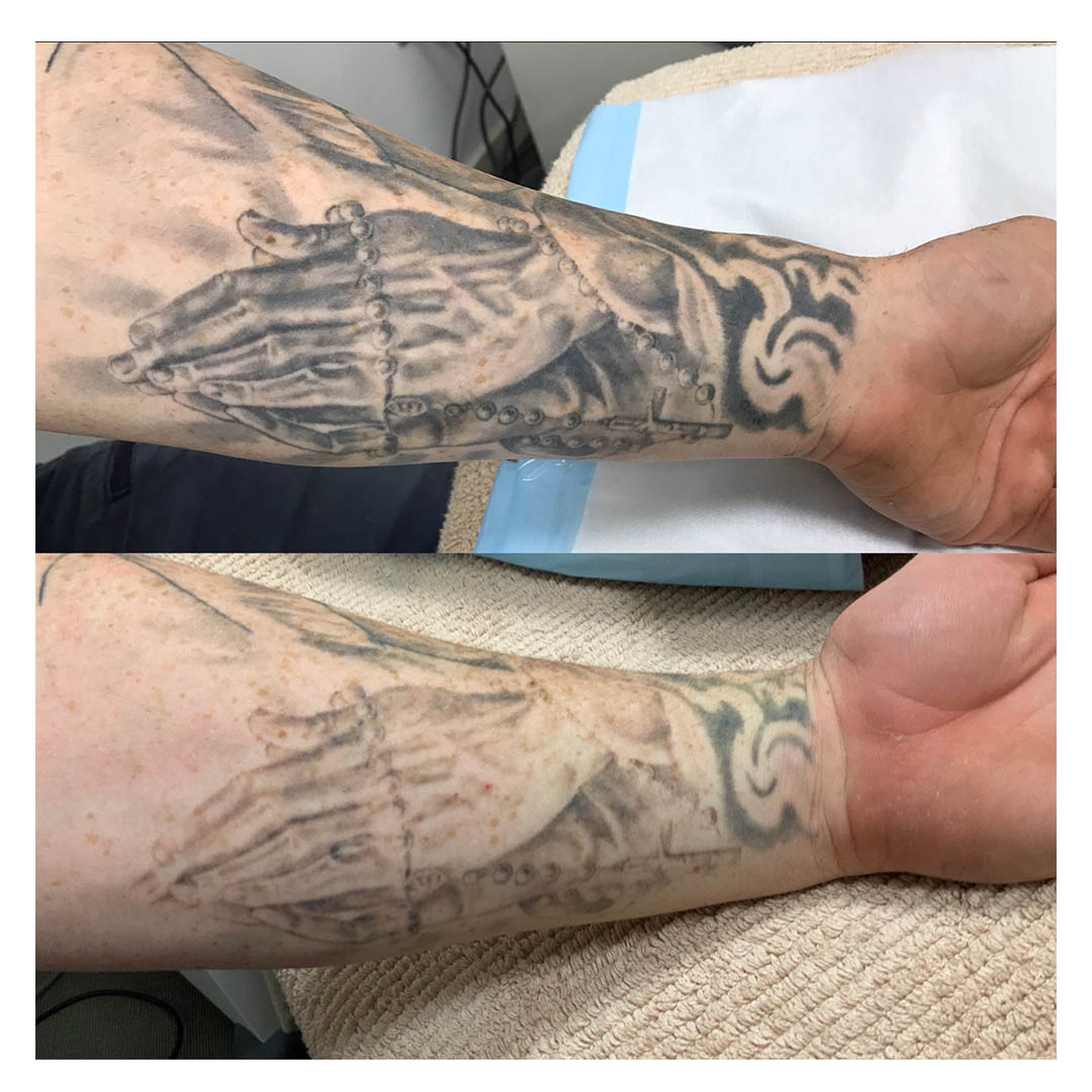 Tattoo-Removal-result