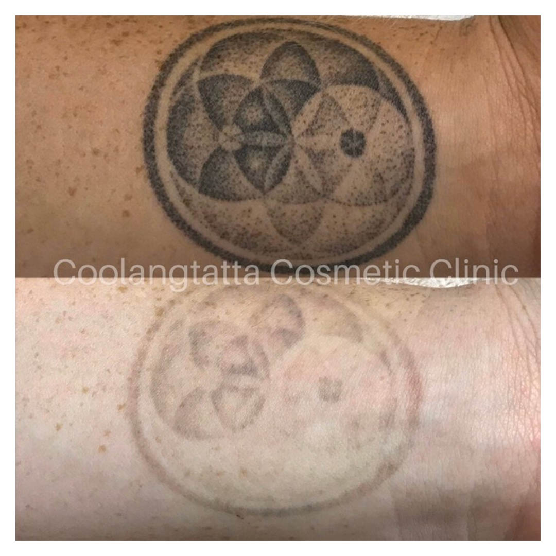 Tattoo-Removal-treated-images