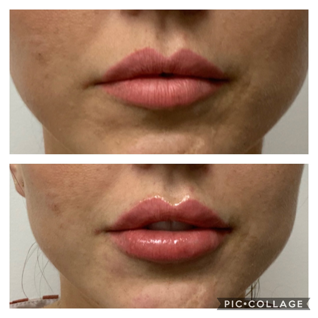 before & after dermal treatment image