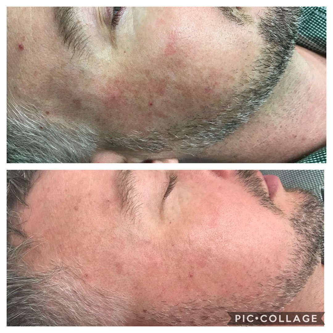 pigmentation treated pictures