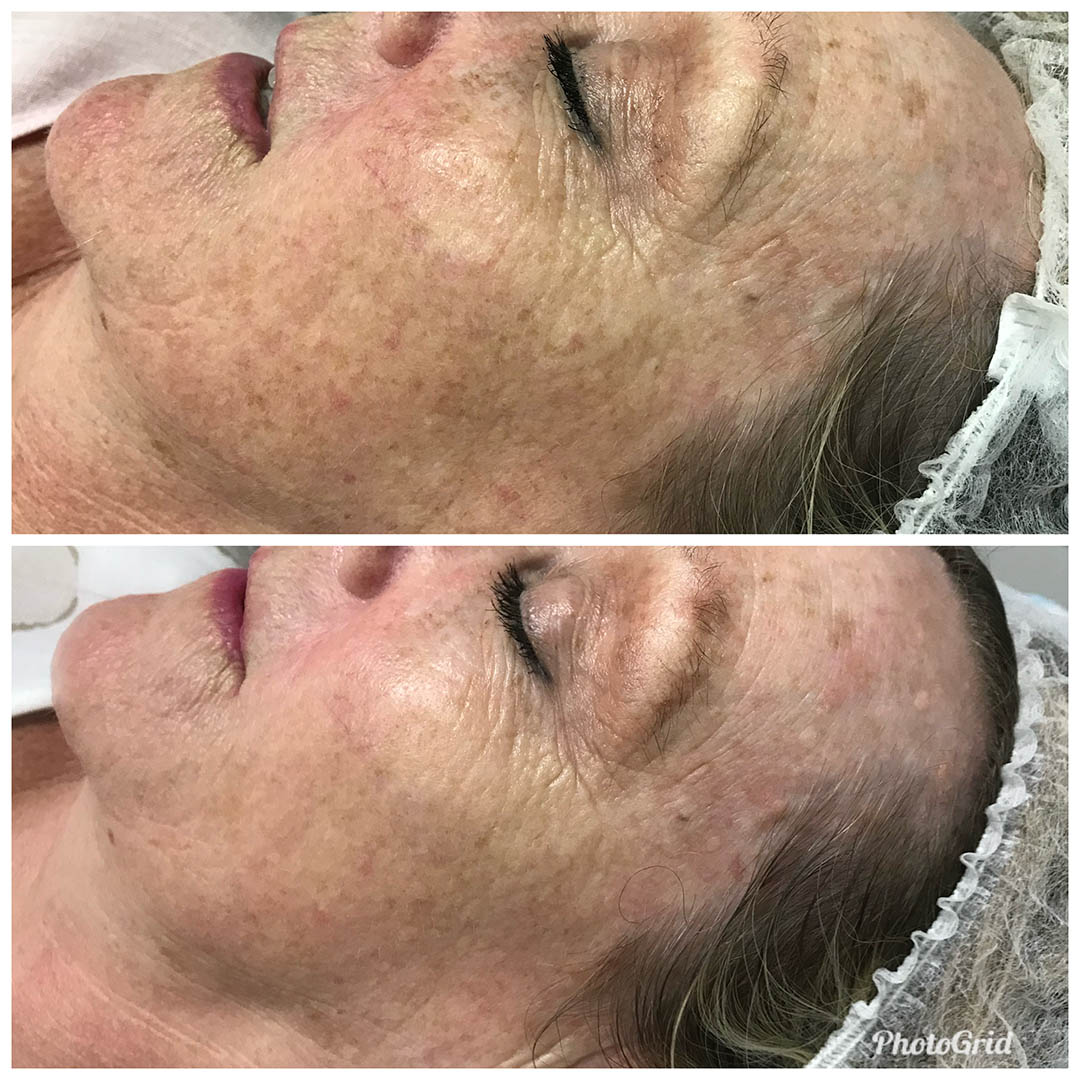 before & after marks treatment
