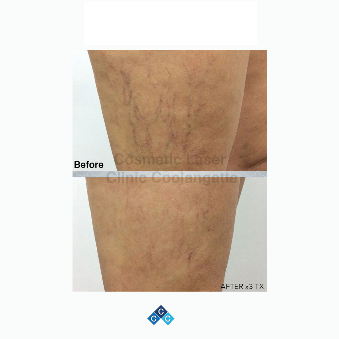 thigh before & after image