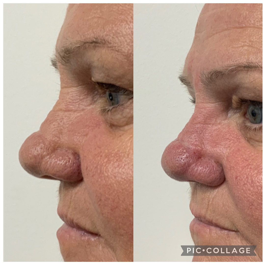 Nose-Correction-before-&-after