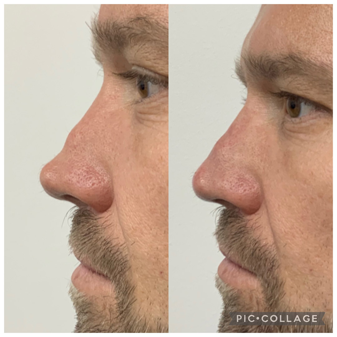 Nose-Correction-result